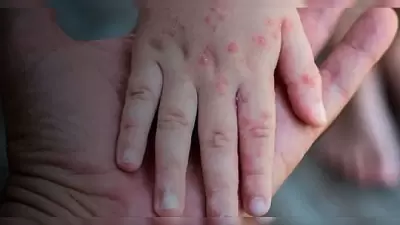 Mpox: veja os sintomas da doença declarada emergência global